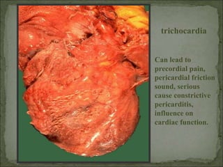 trichocardia
Can lead to
precordial pain,
pericardial friction
sound, serious
cause constrictive
pericarditis,
influence on
cardiac function.
 