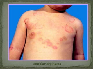 annular erythema
 