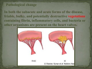 Pathological change
In both the subacute and acute forms of the disease,
friable, bulky, and potentially destructive vegetations
containing fibrin, inflammatory cells, and bacteria or
other organisms are present on the heart valves.
 