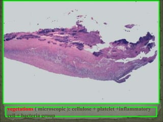 vegetations ( microscopic ): cellulose + platelet +inflammatory
cell + bacteria group
 