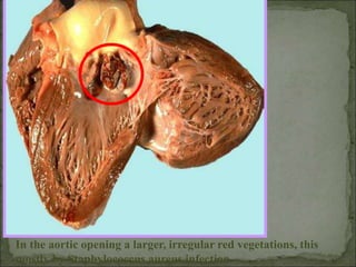 In the aortic opening a larger, irregular red vegetations, this
mostly by Staphylococcus aureus infection.
 