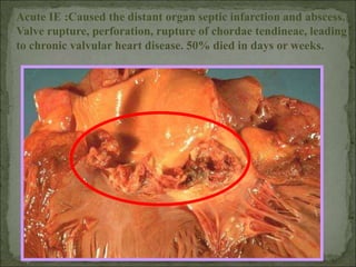 Acute IE :Caused the distant organ septic infarction and abscess.
Valve rupture, perforation, rupture of chordae tendineae, leading
to chronic valvular heart disease. 50% died in days or weeks.
 