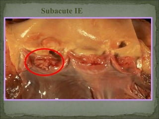Subacute IE
 