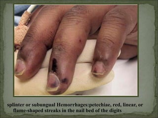 splinter or subungual Hemorrhages:petechiae, red, linear, or
flame-shaped streaks in the nail bed of the digits
 