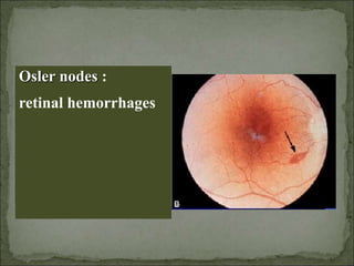 Osler nodes :
retinal hemorrhages
 