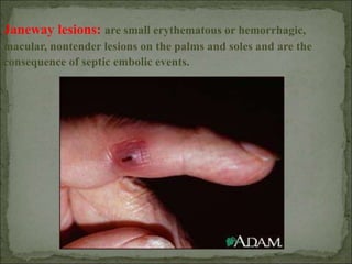 Janeway lesions: are small erythematous or hemorrhagic,
macular, nontender lesions on the palms and soles and are the
consequence of septic embolic events.
 