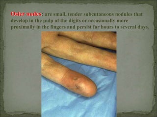 Osler nodes: are small, tender subcutaneous nodules that
develop in the pulp of the digits or occasionally more
proximally in the fingers and persist for hours to several days.
 
