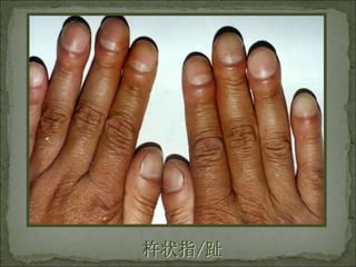 杵状指/趾
 