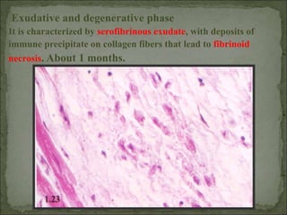 Exudative and degenerative phase
It is characterized by serofibrinous exudate, with deposits of
immune precipitate on collagen fibers that lead to fibrinoid
necrosis. About 1 months.
 