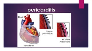 Myocarditis, Rheumatic Heart Disease & Pericarditis: Inflammatory Heart ...