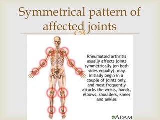 
Symmetrical pattern of
affected joints
 