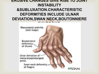 
EROSIVE CHANGES GIVE RISE TO JOINT
INSTABILITY
&SUBLUXATION.CHARACTERISTIC
DEFORMITIES INCLUDE ULNAR
DEVIATION,SWAN NECK,BOUTONNIERE
SYNDROME.
 