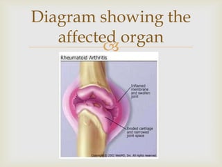 
Diagram showing the
affected organ
 