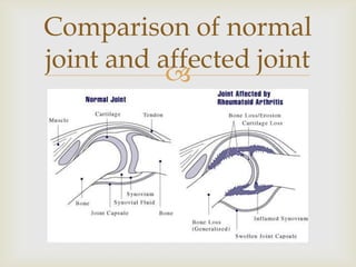 
Comparison of normal
joint and affected joint
 