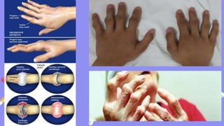 Rheumatoid arthritis.pptx
