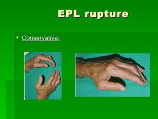 The Hand therapist's role: Rheumatoid Thumb - Splinting/Rehabilitation ...