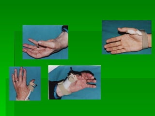The Hand therapist's role: Rheumatoid Thumb - Splinting/Rehabilitation ...