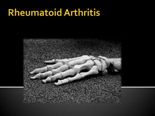 Rheumatoid Arthritis 