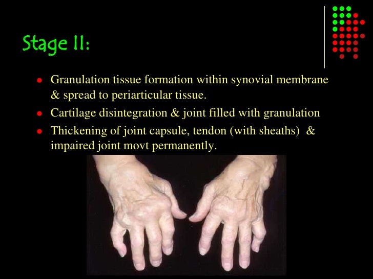 Rheumatoid arthritis
