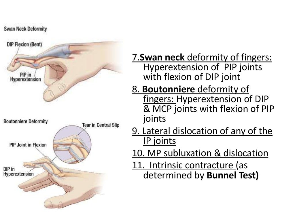 Rheumatoid arthritis for undergraduates
