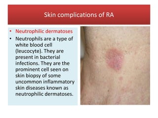 Neutropenic Skin Rash Rheumatoid arthritis | PPTX
