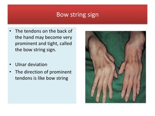 Rheumatoid arthritis | PPTX