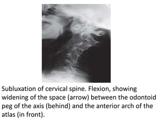 Subluxation of cervical spine. Flexion, showing
widening of the space (arrow) between the odontoid
peg of the axis (behind...