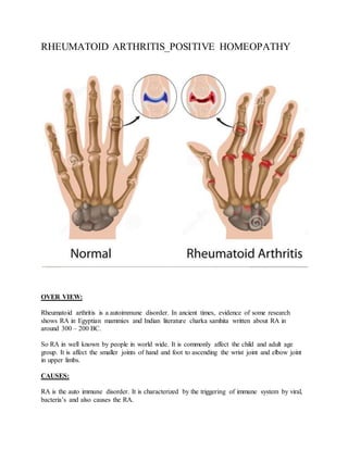 RHEUMATOID ARTHRITIS_POSITIVE HOMEOPATHY
OVER VIEW:
Rheumatoid arthritis is a autoimmune disorder. In ancient times, evidence of some research
shows RA in Egyptian mammies and Indian literature charka samhita written about RA in
around 300 – 200 BC.
So RA in well known by people in world wide. It is commonly affect the child and adult age
group. It is affect the smaller joints of hand and foot to ascending the wrist joint and elbow joint
in upper limbs.
CAUSES:
RA is the auto immune disorder. It is characterized by the triggering of immune system by viral,
bacteria’s and also causes the RA.
 