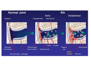 Rheumatoid arthritis | PPT