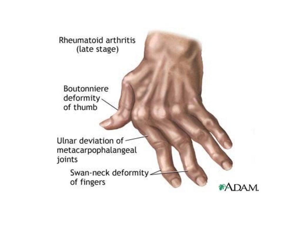 Rheumatoid arthritis