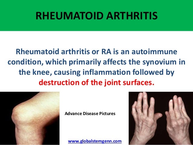 Medical Facts of STEM CELL THERAPY in Rheumatoid Arthritis Medical Facts of STEM CELL THERAPY in Rheumatoid Arthritis
