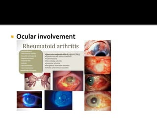  Ocular involvement
 