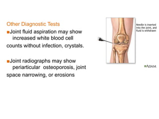 Other Diagnostic Tests
■Joint fluid aspiration may show
increased white blood cell
counts without infection, crystals.
■Joint radiographs may show
periarticular osteoporosis, joint
space narrowing, or erosions
 