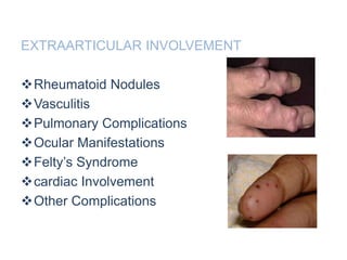EXTRAARTICULAR INVOLVEMENT
Rheumatoid Nodules
Vasculitis
Pulmonary Complications
Ocular Manifestations
Felty’s Syndrome
cardiac Involvement
Other Complications
 