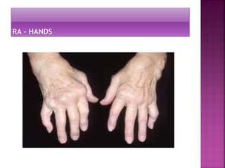 rheumatoid arthritis - 161025073117.pptx