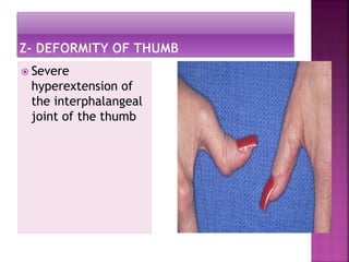 Rheumatoid Arthritis PPTX rheumatoid-arthritis-pptx