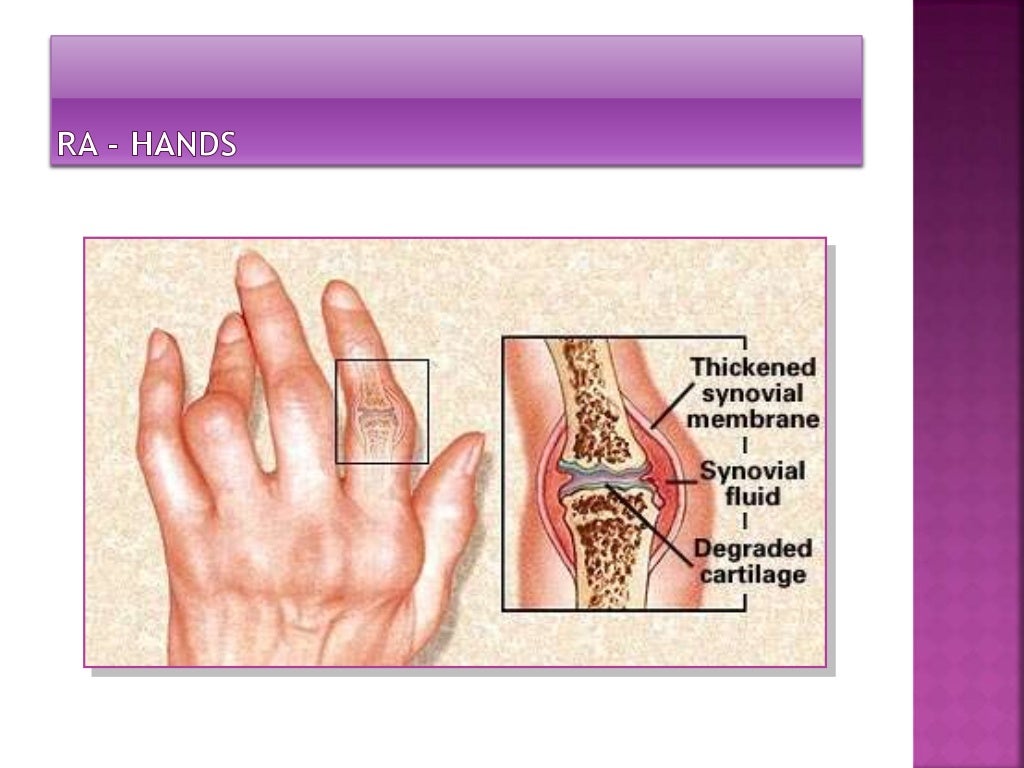 Rheumatoid arthritis
