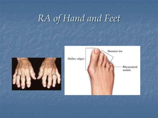 Rheumatoid arthritis | PPT