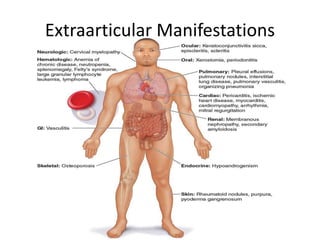 Extraarticular Manifestations
 