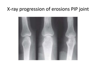 X-ray progression of erosions PIP joint
 