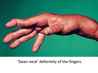 ‘Swan neck’ deformity of the fingers.
 