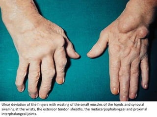 Ulnar deviation of the fingers with wasting of the small muscles of the hands and synovial
swelling at the wrists, the extensor tendon sheaths, the metacarpophalangeal and proximal
interphalangeal joints.
 