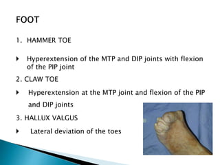 1. HAMMER TOE
 Hyperextension of the MTP and DIP joints with flexion
of the PIP joint
2. CLAW TOE
 Hyperextension at the MTP joint and flexion of the PIP
and DIP joints
3. HALLUX VALGUS
 Lateral deviation of the toes
 