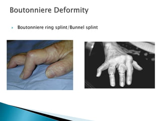  Boutonniere ring splint/Bunnel splint
 