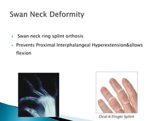  Swan neck ring splint orthosis
 Prevents Proximal Interphalangeal Hyperextension&allows
flexion
 