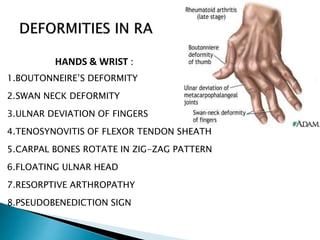 HANDS & WRIST :
1.BOUTONNEIRE’S DEFORMITY
2.SWAN NECK DEFORMITY
3.ULNAR DEVIATION OF FINGERS
4.TENOSYNOVITIS OF FLEXOR TENDON SHEATH
5.CARPAL BONES ROTATE IN ZIG-ZAG PATTERN
6.FLOATING ULNAR HEAD
7.RESORPTIVE ARTHROPATHY
8.PSEUDOBENEDICTION SIGN
 