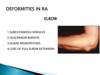 ELBOW
1.SUBCUTANEOUS NODULES
2.OLECRANON BURSITIS
3.ULNAR NEUROPATHIES
4.LOSS OF FULL ELBOW EXTENSION
 