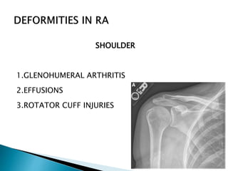 SHOULDER
1.GLENOHUMERAL ARTHRITIS
2.EFFUSIONS
3.ROTATOR CUFF INJURIES
 