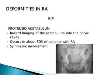 HIP
PROTRUSIO ACETABULUM
 Inward bulging of the acetabulum into the pelvic
cavity.
 Occurs in about 50% of patients with RA
 Symmetric involvement
 