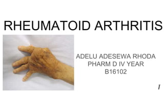 RHEUMATOID ARTHRITIS
ADELU ADESEWA RHODA
PHARM D IV YEAR
B16102
1
 